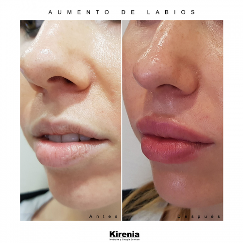 Antes y despu�s Aumento de labios